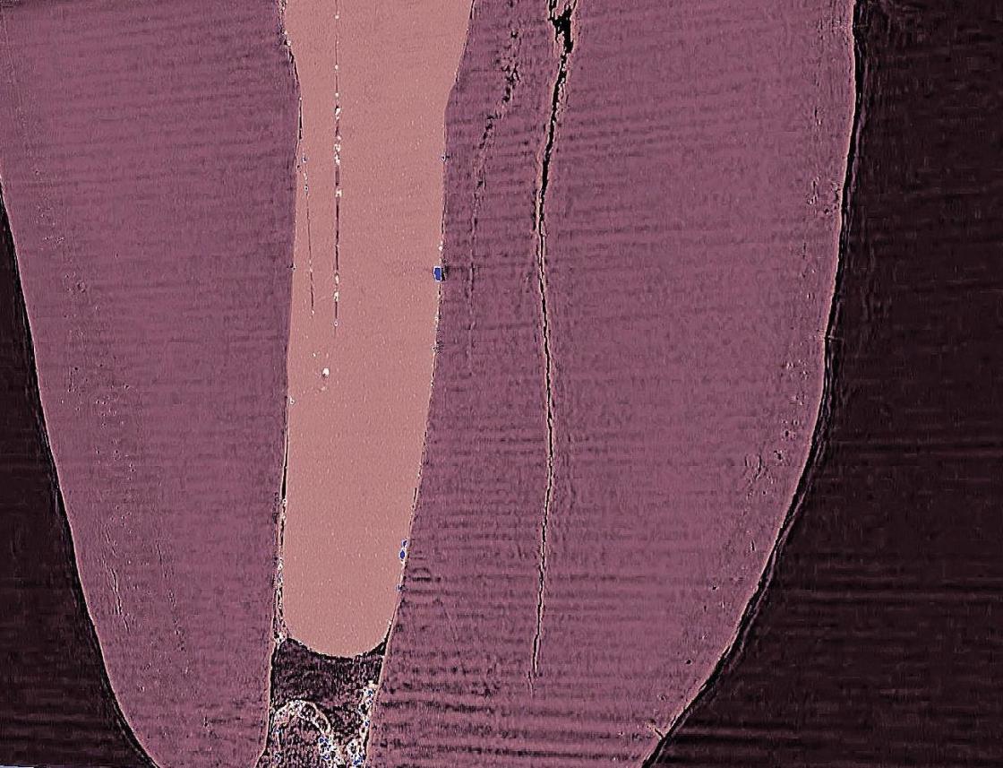 Das Bild zeigt Details an der Grenze zwischen Fllung und Zahnwurzel - vergrerte Ansicht